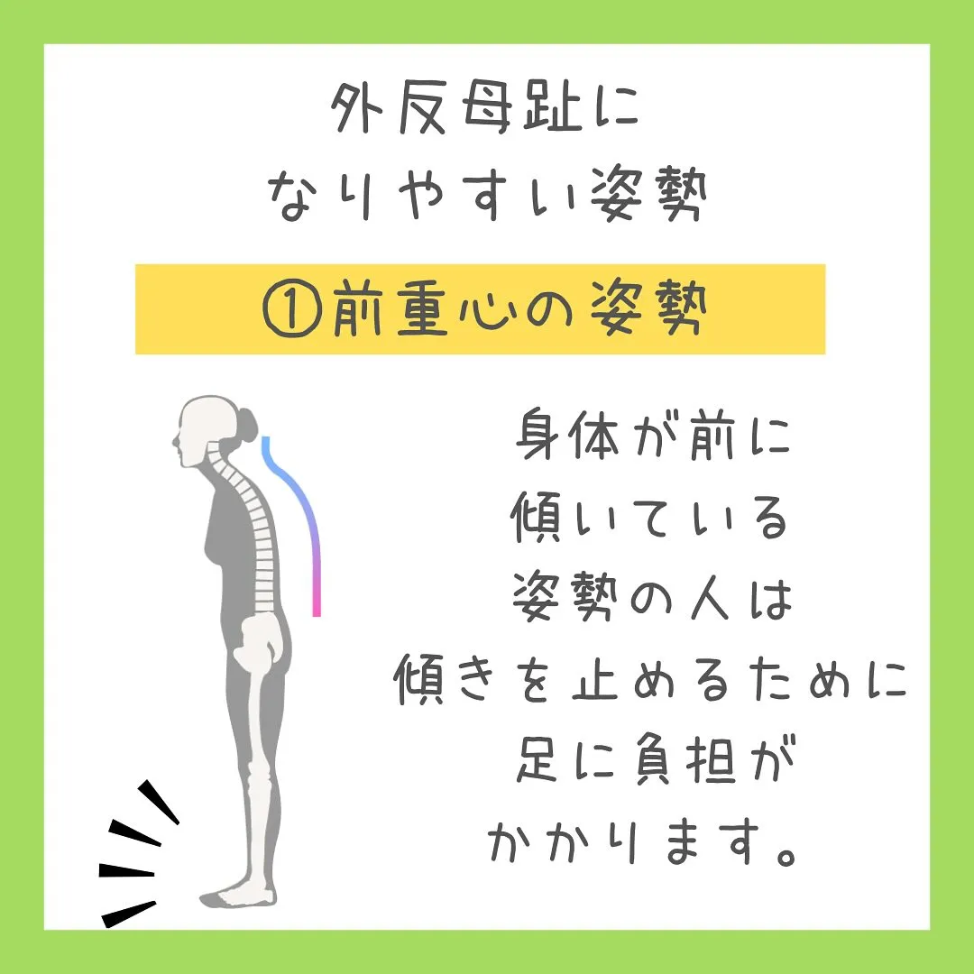 「外反母趾は姿勢バランスで起こる？！」足のお悩みないですか？